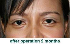 plastic-surgery-blepharoplasty